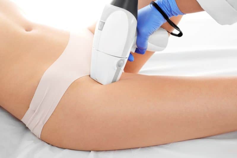 epilazione donna