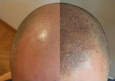 effetto punto pelo