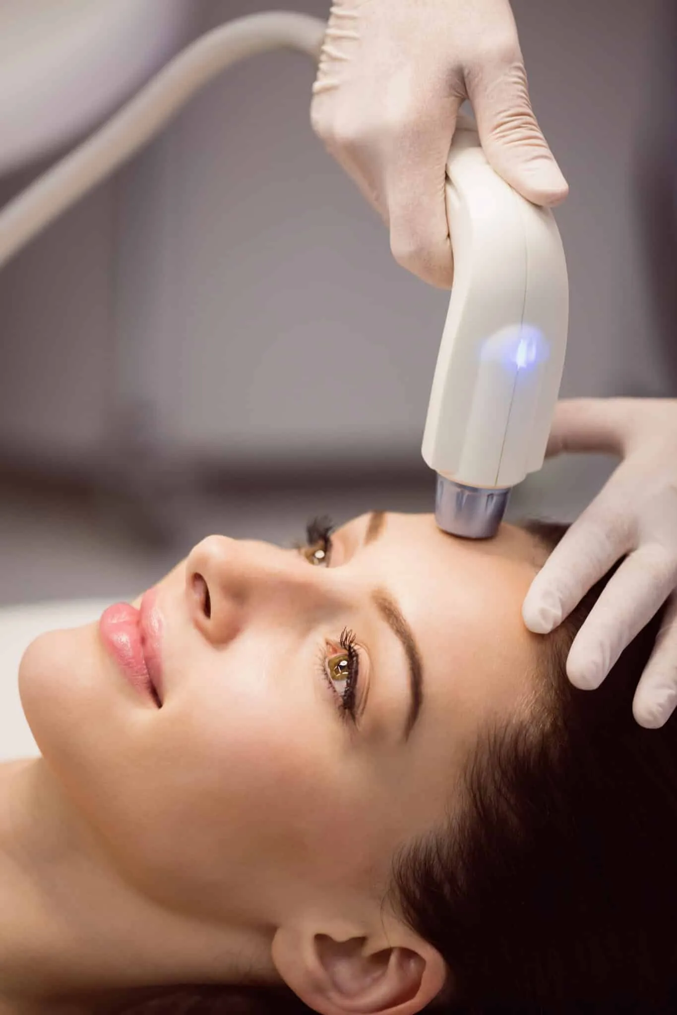 eliminazione macchie viso laser