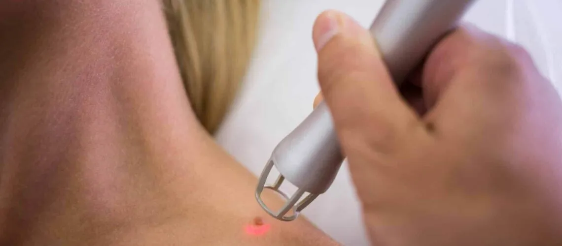 trattamento laser macchie viso