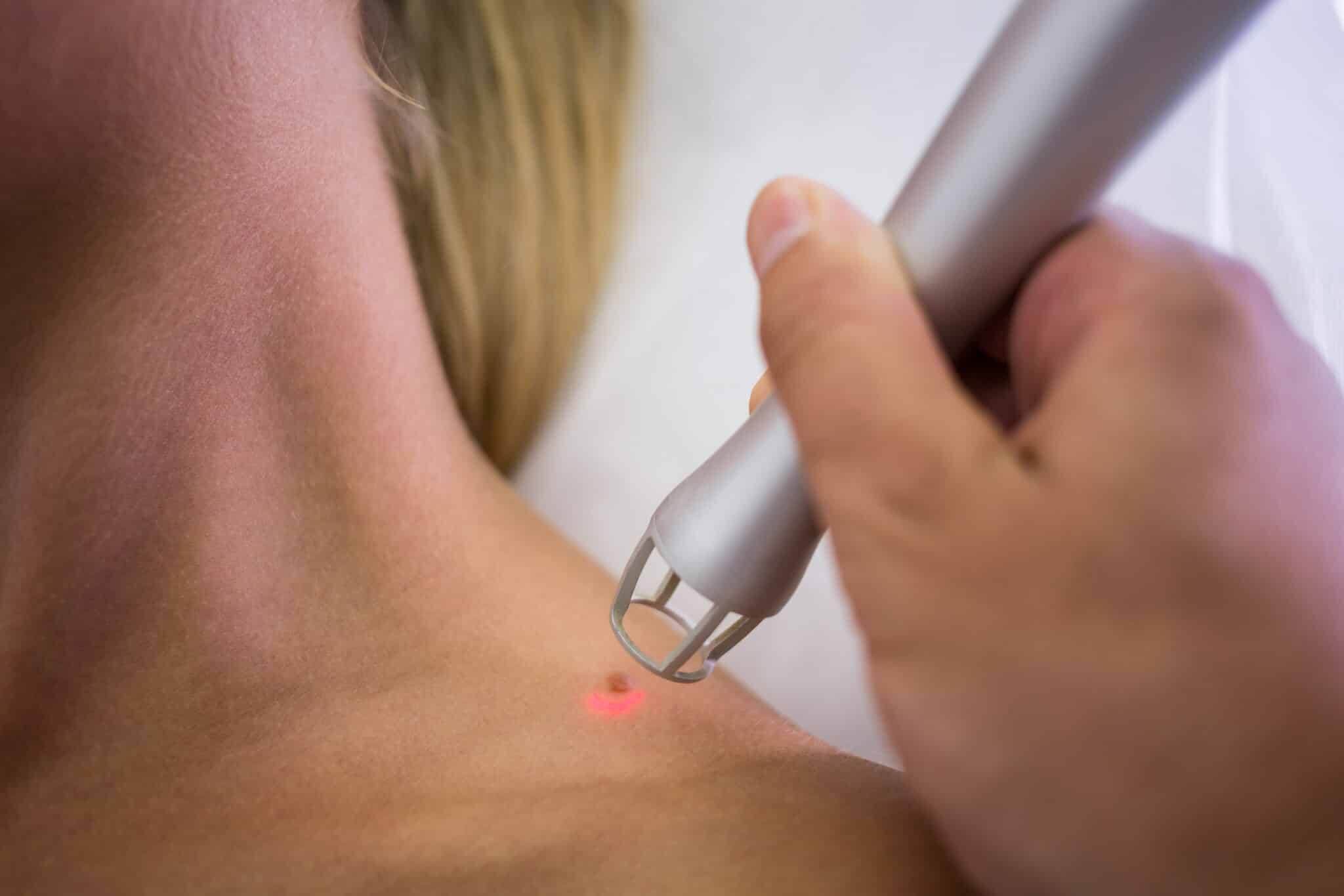 trattamento laser macchie viso